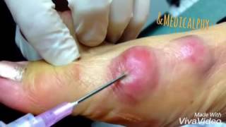 Ganglion cyst aspiration [upl. by Grosberg]