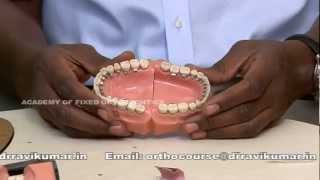 Lingual Orthodontics Course [upl. by Nodnek]