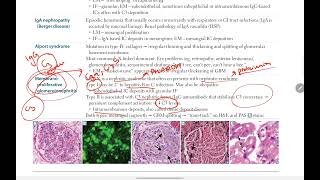 Membranoproliferative Glomerulonephritis  First Aid USMLE Step 1  BACK BENCHERS ACADEMY [upl. by Adrial673]