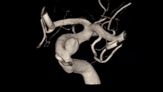 Intracranial aneurysm embolization Comaneci [upl. by Awad543]