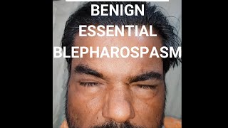 Benign essential blepharospasm BEB shorts [upl. by Cate]