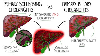 Primary Sclerosing Cholangitis v Primary Biliary Cholangitis Primary Biliary Cirrhosis [upl. by Hodess9]