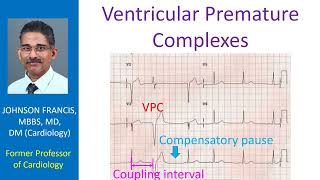 Ventricular Premature Complexes [upl. by Eglanteen]