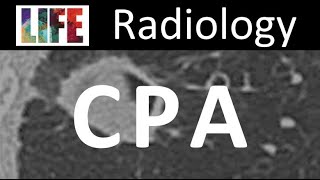 Radiology of chronic pulmonary aspergillosis [upl. by Ancel378]