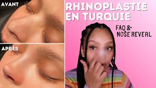 RHINOPLASTIE EN TURQUIE  Prix douleurs chirurgien [upl. by Malachy390]