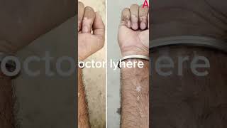 Vitiligo before and after viralvideo trending whitepatches skincare doctoriyhere [upl. by Gilberto35]