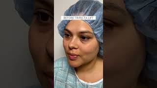 Before amp After Trifecta Lift  Latina Patient  Dr Kami Parsa Beverly Hills [upl. by Namor913]