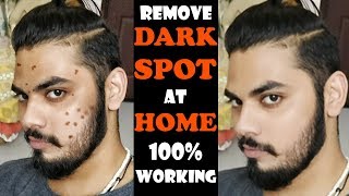 Remove Dark Spot at Home Naturally  Homemade Treatment For Dark Spot amp Acne  Asad Ansari [upl. by Gilder]