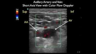 How To Axillary Vein Cannulation  Sonosite Ultrasoundmp4 [upl. by Bailar772]