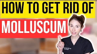 How To Get Rid Of Molluscum FAST  Dermatologist Tips [upl. by Anaiek]