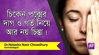 পক্সের দাগ দূর করার উপায়  Chicken pox spots treatment  Dr Natasha Nasir  Goodie Life  2021 [upl. by Dnalkrik]