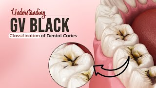 Understanding GV Black Classification of Dental Caries  Dentalkart [upl. by Adnolaj]