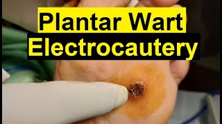 Treatment of Viral Warts  Electrocautery Procedure [upl. by Gaven]