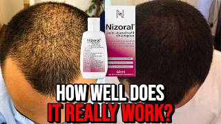 Ketoconazole Shampoo for Hair Growth  How Well Does it REALLY Work [upl. by Muir]