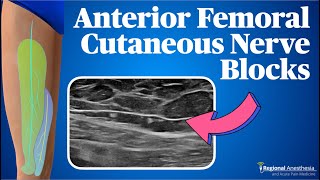 Anterior Femoral Cutaneous Nerve Block The Cuties [upl. by Nivart]